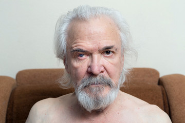 Eye disease in an old man