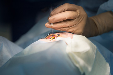 Laser surgery for vision correction