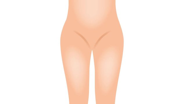 Liposuction before and after , fat , cosmetic . step of Liposuction graphic animation / hip