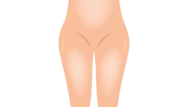 Liposuction before and after , fat , cosmetic . step of Liposuction graphic animation / hip / slow version