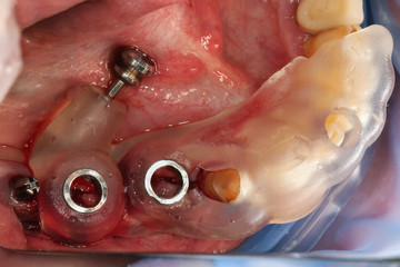 Dental standard template for implanting during surgery exactly