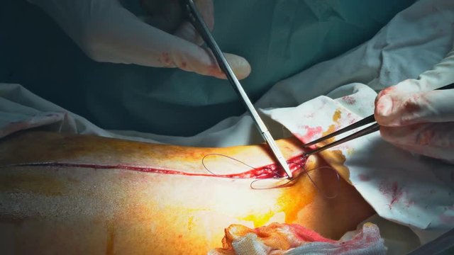Surgeons suturing a long on sick patient after performing a serious surgery. Close-up of surgeon,