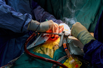 Teamwork surgeons during openheart surgery doctor holding surgical instruments