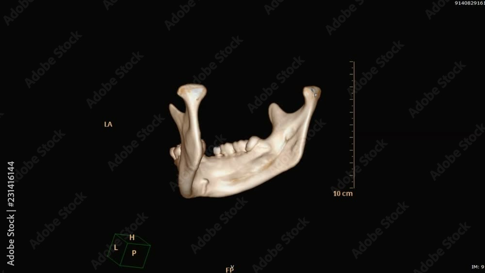 Poster 3d rendering image of mandible / jaw from ct scanner rotating on the screen .