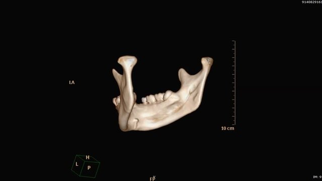 3D rendering image of Mandible / jaw from CT scanner  rotating on the screen .