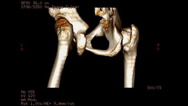 CT SCAN image of pelvic bone / Hip bone 3D rendering image show fracture left hip joint Rotating on monitor .