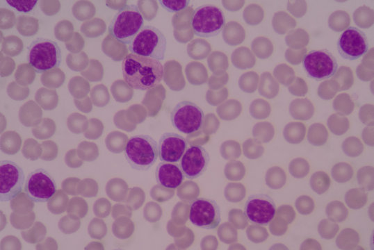 Moderatr blast cells on red blood cell background.