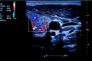 Colourful image of modern ultrasound monitor