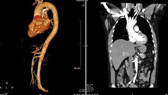 computed tomographic angiography ( CTA ) of Thoracic Aorta 3D rendering image  VS CORONAL PLANE rotating on monitor. Medical technology Concept.