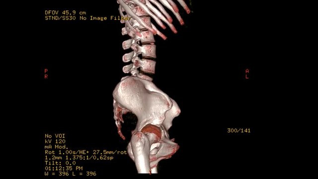 CT SCAN image of lumbar spine rendering image. Rotating on monitor .
