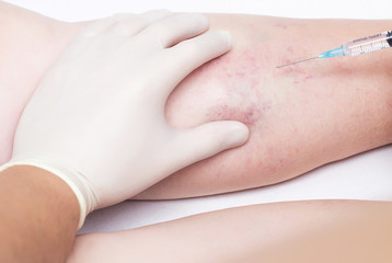 A doctor makes an injection to the varicose veins on a woman s leg, close-up, sclerotherapy,...