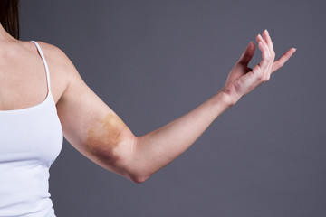 Bruises on the woman's hands, arms with extensive hematoma