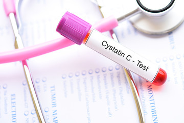 Blood sample tube for cystatin C test, diagnosis for renal disease
