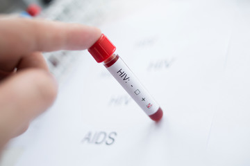 Diagnostician holding in hand a positive HIV test.