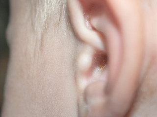 Earwax, dirty ears of a little boy close up