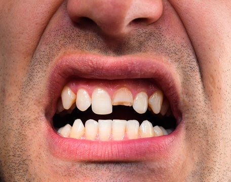 Broken tooth. Broken upper incisor in a man mouth. Man shows oral cavity to the dentist. Treatment of a broken tooth.