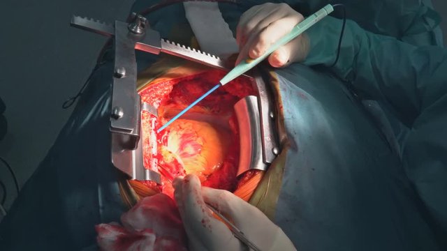 Heart surgery. Open heart surgery suture greater saphenous vein coronary artery bypass surgery