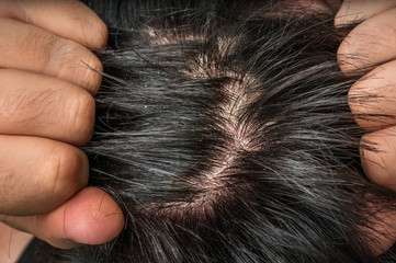 Closeup view of hair of a man with dandruff