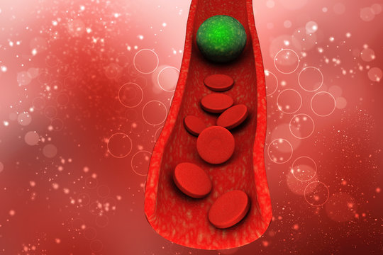 3d rendering blood cells with plaque buildup of cholesterol symbol of vascular illness
 