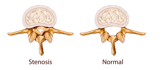 white background vector illustration of a Stenosis illustration