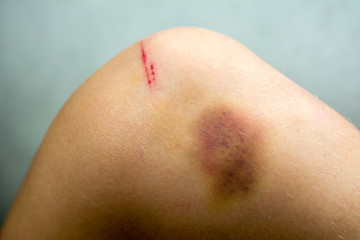 Fototapeta premium Closeup on a large bruise on woman leg skin. Pain concept
