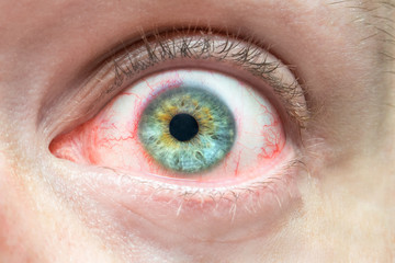 Fototapeta premium Mens irritated red eye close up, problems with blood vessels, fatigue chronic conjunctivitis