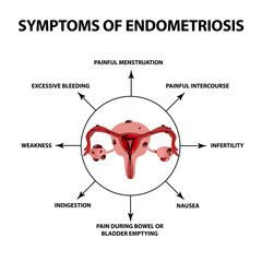 Symptoms of endometriosis. The uterus ovaries structure. Infographics. Vector illustration on isolated background
