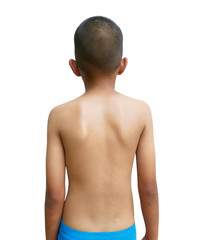 scoliosis in children