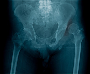 dislocation of left hip joint