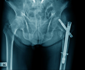 hip fixation for old patient with hip fracture