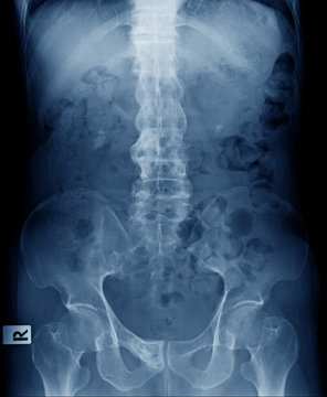 x-ray image of old man show ankylosing spondylitis or bamboo spine