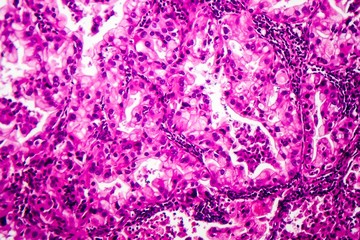 Histopathology of lung cancer