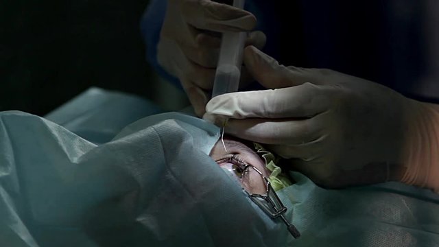 anesthesia before surgery laser vision correction, ophthalmology operation, Surgeon's hands in gloves performing laser eye vision correction correction, surgery eye,  Cataract surgery