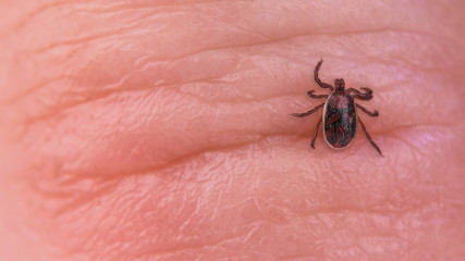 Brown dog tick parasite. Skin close-up. Rhipicephalus sanguineus. Ixodida. Infected mite on wrinkled human finger detail. Tick-borne diseases carrier. Canine babesiosis, ehrlichiosis, hepatozoonosis.