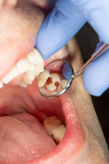 Dental caries. Filling with dental composite photopolymer material using rabbders. The concept of...