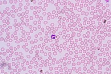 Study of white blood cells are the cells of the immune system under the microscope in laboratories.