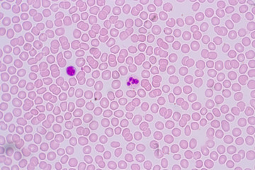 Study of white blood cells are the cells of the immune system under the microscope in laboratories.