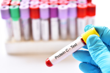 Obraz premium Test tube with blood sample for protein C test, coagulation disorder diagnosis