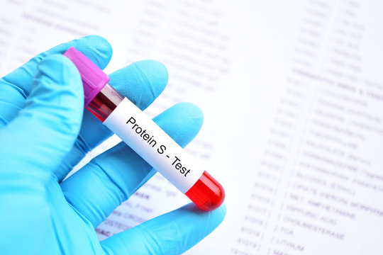 Test tube with blood sample for protein S test, coagulation disorder diagnosis