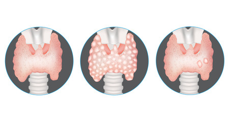 Thyroid gland diseases. Healthy thyroid, multinodular goiter and gland with nodules. 