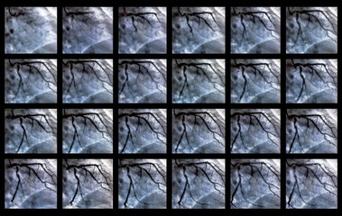Catheterization. Cardiac ventriculography is a medical imaging test used to determine a patient...