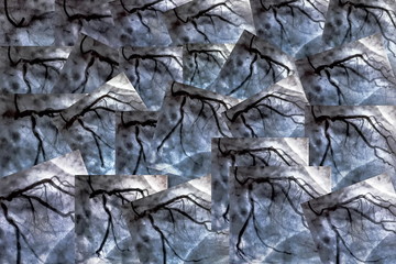 Catheterization. Cardiac ventriculography is a medical imaging test used to determine a patient cardiac function in the right or left ventricle. Collage