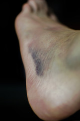 Ankle bruises, injuries caused by running