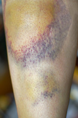 Macro shot of bruise on skin