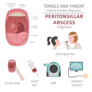 Tonsils and throat diseases. Peritonsillar abscess symptoms, treatment icon set. Medical infographic design
