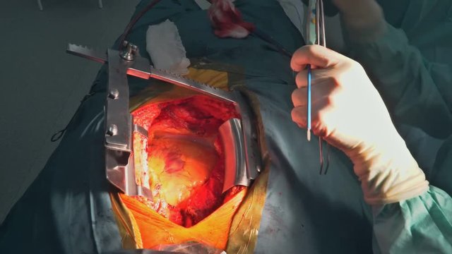 Surgeons team operating heart operating live shot