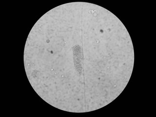 Significance Cast of Urinary under 40X light microscope, Waxy cast
