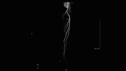 computed tomography angiography, CTA of lower extremity , CTA femoral artery  3D rendering image with MIP method.