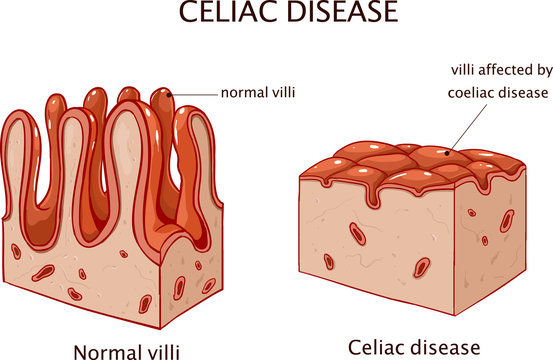 Coeliac disease or celiac disease. small bowel showing coeliac disease manifested by blunting of villi.