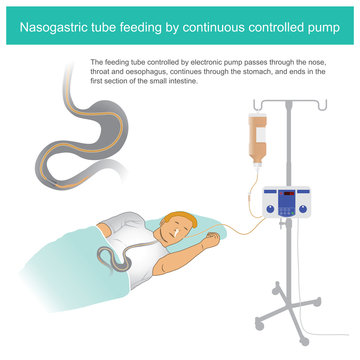 Nasogastric Tube Feeding By Continuous Controlled Pump. The Feeding Tube Controlled By Electronic Pump Passes Through The Nose